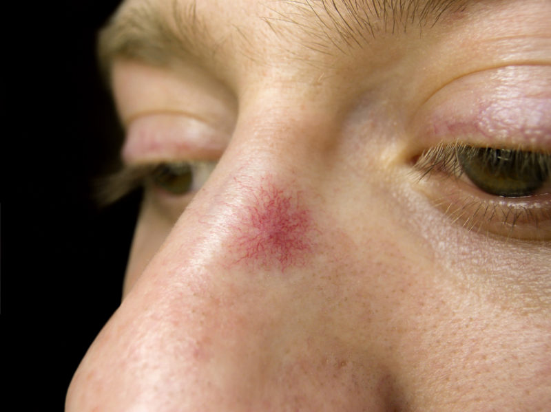 Telangiectasia in a star-like pattern affecting the nose.