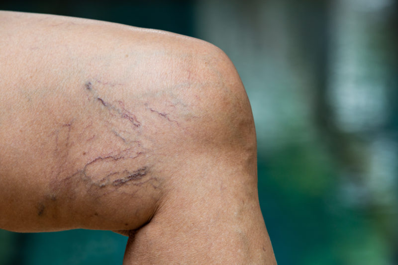 Picture of the left leg showing underlying varicose veins.