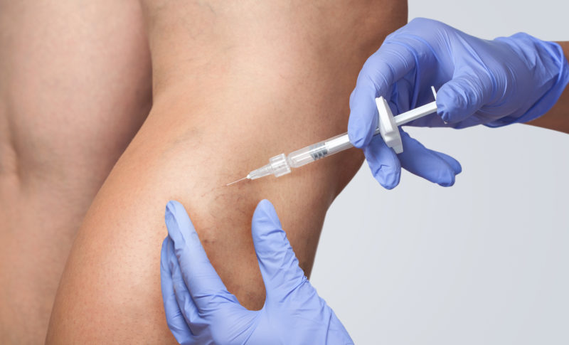 Picture demonstrating sclerotherapy being performed on the right leg.