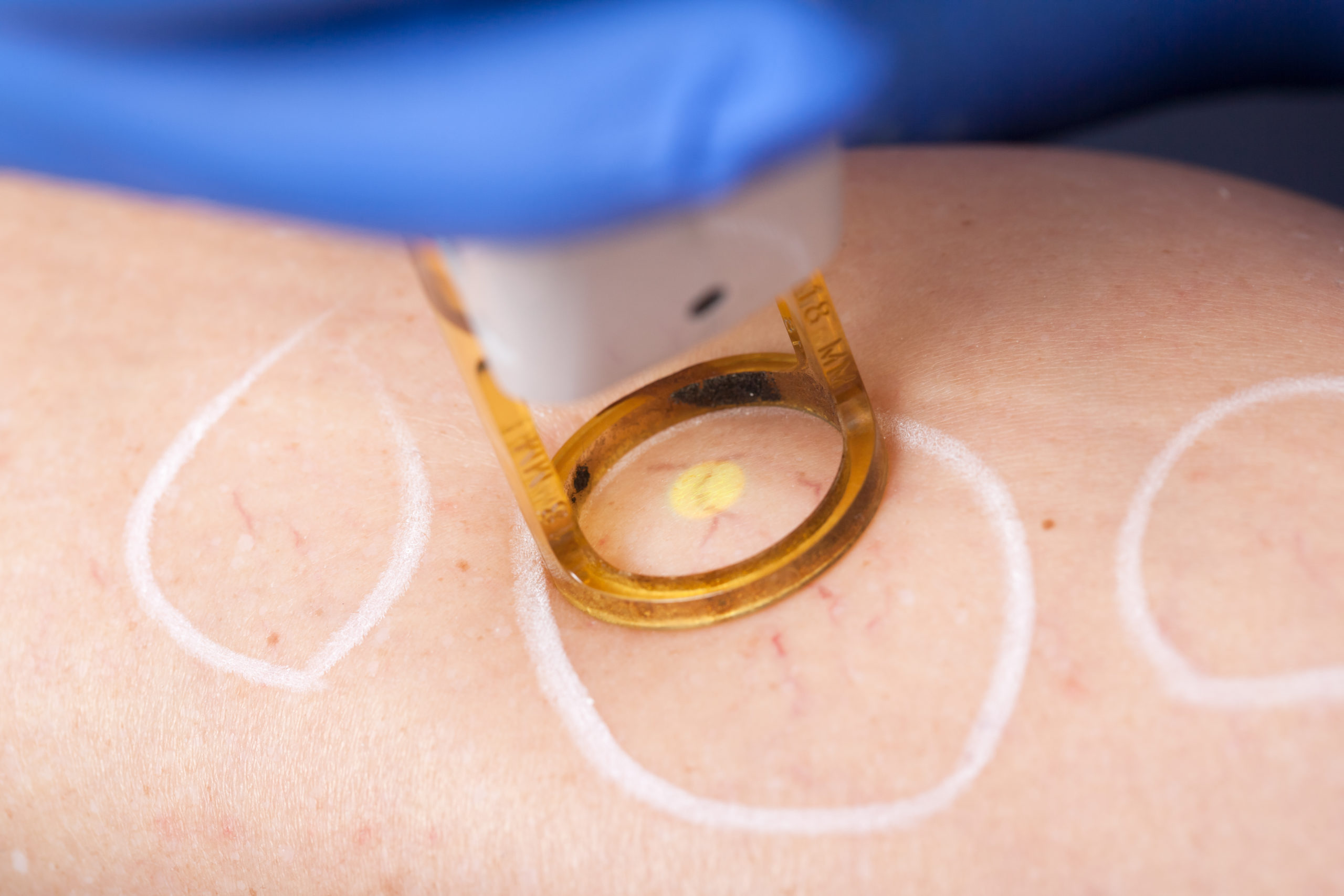 Spider Veins Being Treated with Skin Laser. Circles Marked for the Laser.