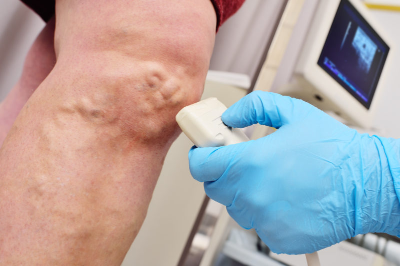 An Ultrasound Scan on Leg Veins Being Performed. This patient has large varicose veins over the knee.