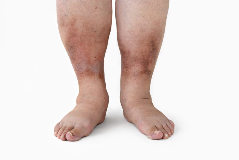 PTS affecting both legs. Swelling, eczema, discolouration are evident. This patient requires long term compression stockings.