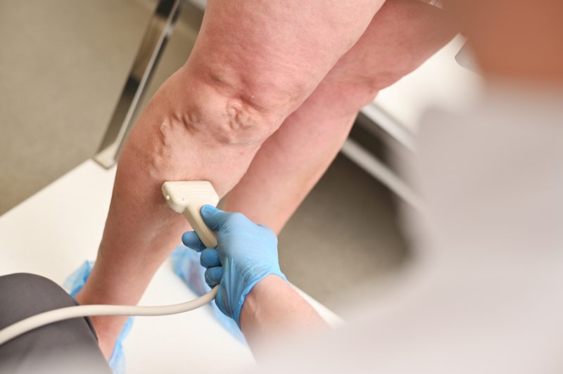 An Ultrasound Scan Performed on Right Leg for Varicose Veins