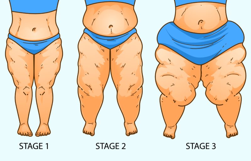Illustration of Three Stages of Lipoedema in Women's Legs with Health Problems