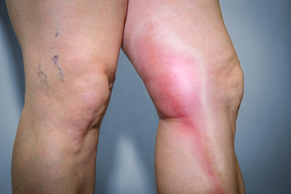 Thrombophlebitis, Leg Veins, Blood Clot on the Surface of Thigh