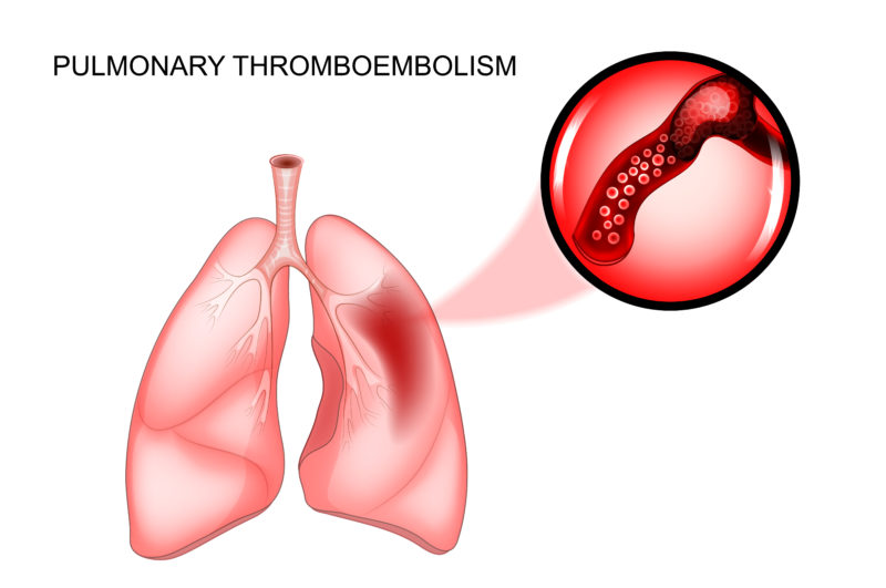 Illustration showing the development of a pulmonary embolism in the left lung caused by SVT