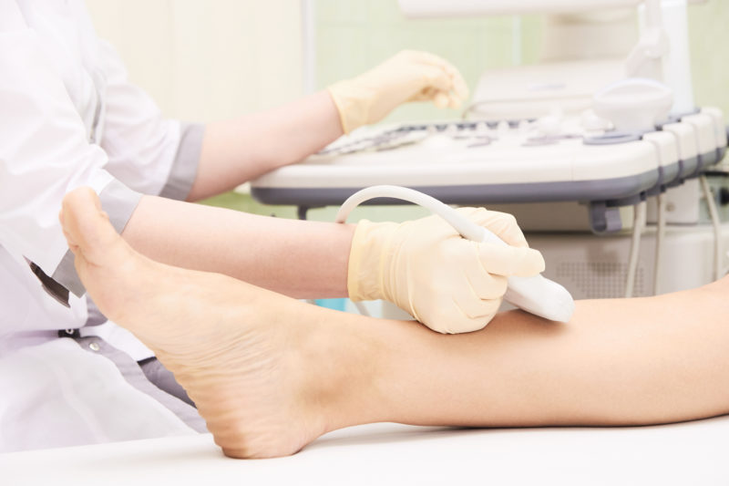 Ultrasound of the legs being performed to look for underlying varicose veins.