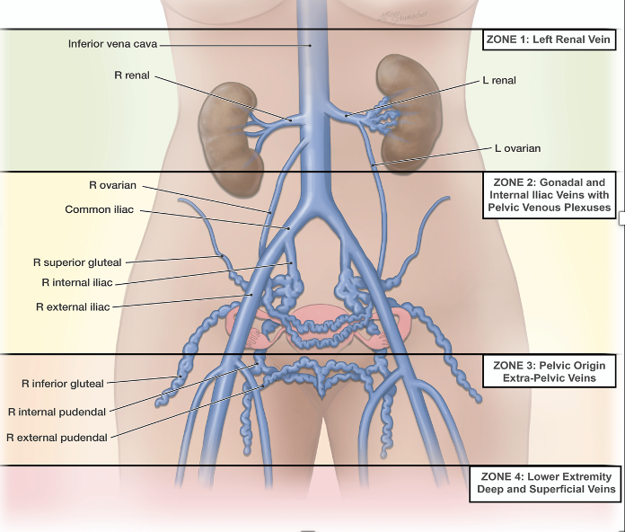 Illustration of Women's Internal Organs Showing Pelvic Venous Veins.