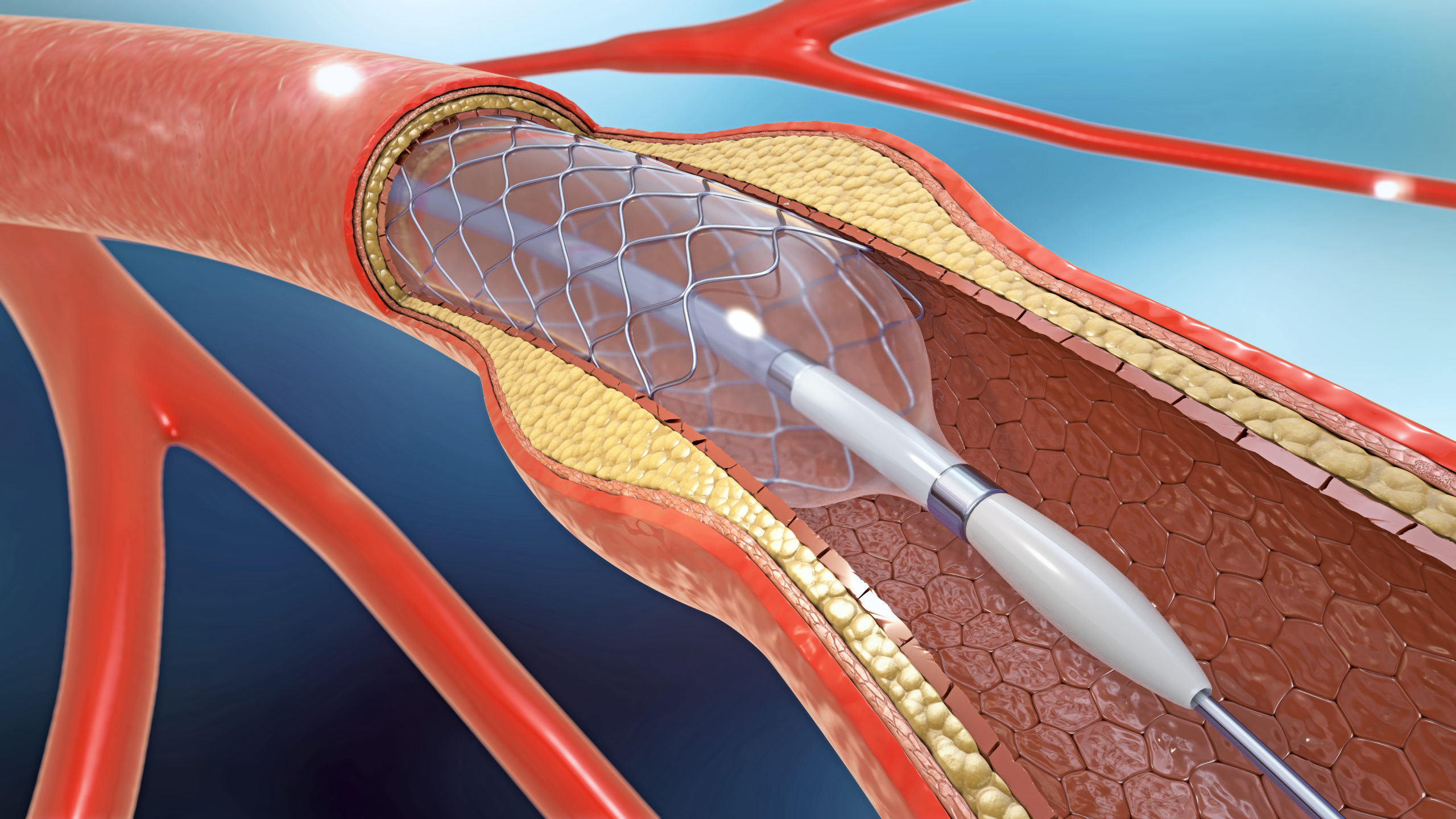 3d Illustration of Stent in Leg ArteryI. Supporting Blood Supply. Unblocks Leg Arteries. Peripheral Arterial Disease. PAD.