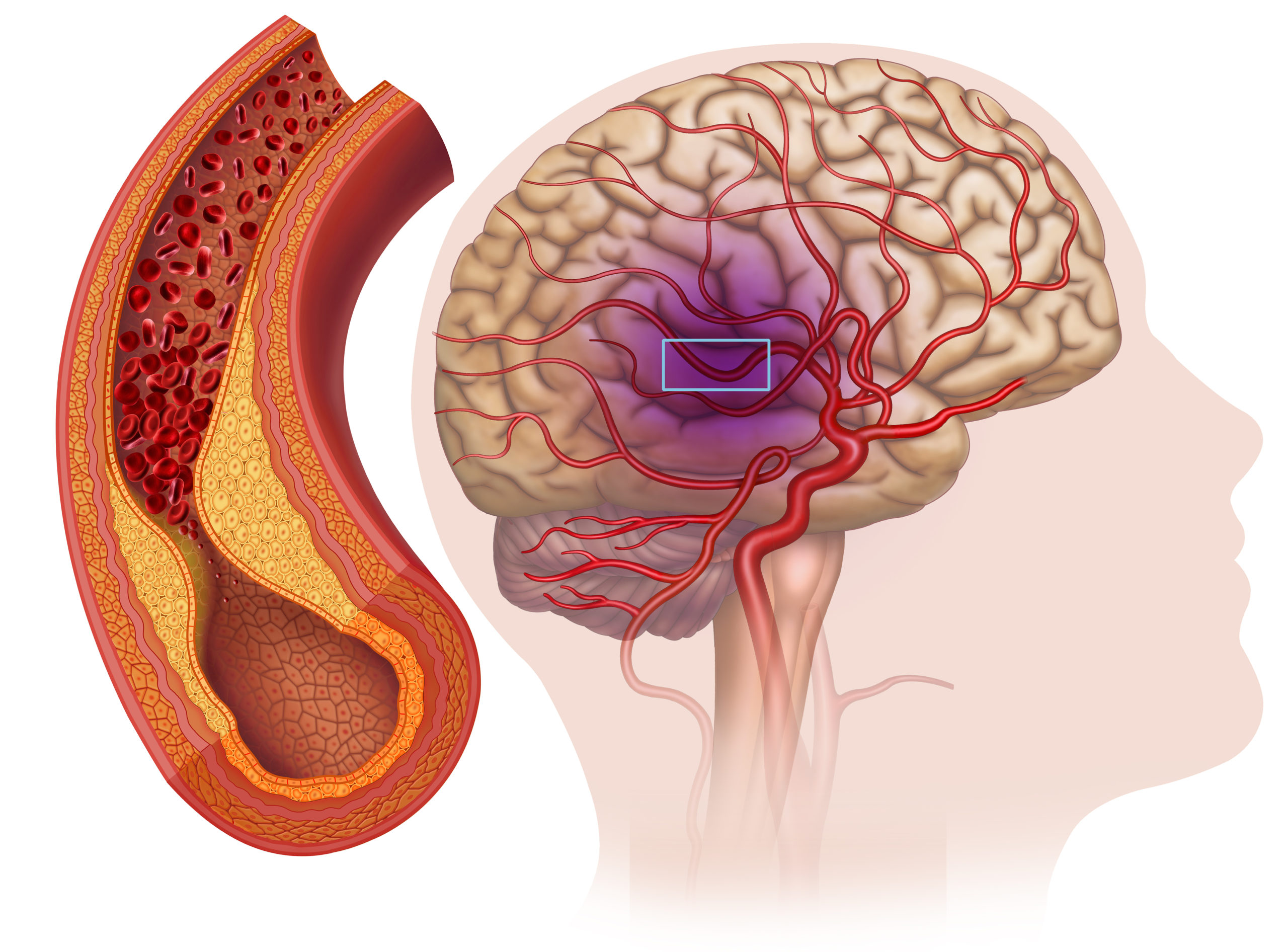 Illustration,Of,Clogged,Cerebral,Arteries,Carotid Artery,Stroke