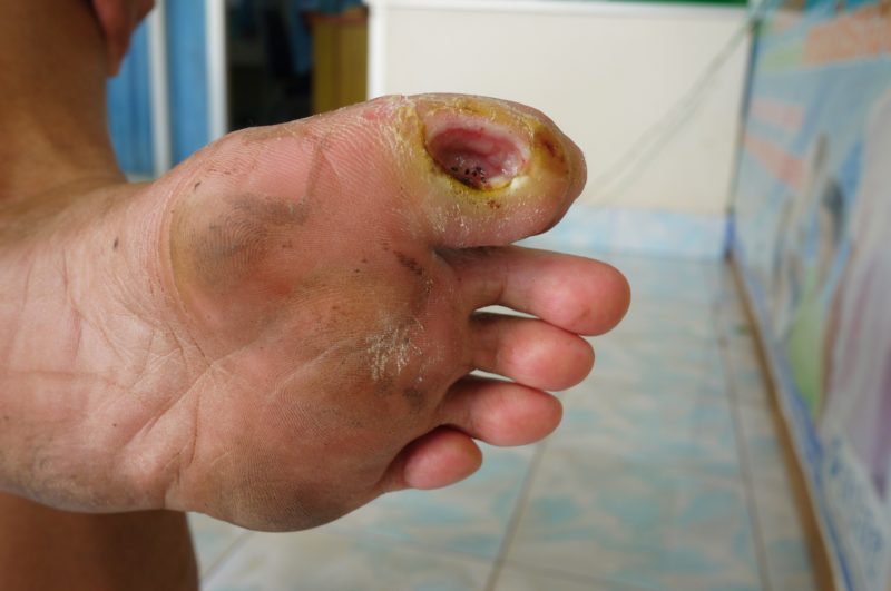 Diabetic Foot Ulcer Showing Deep Wound on the Big Toe, with skin thickening, also called callus.