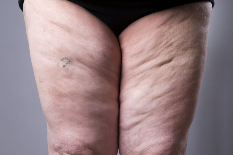 Varicose Veins Closeup. Showing Leg Swelling of Thighs on a Woman.