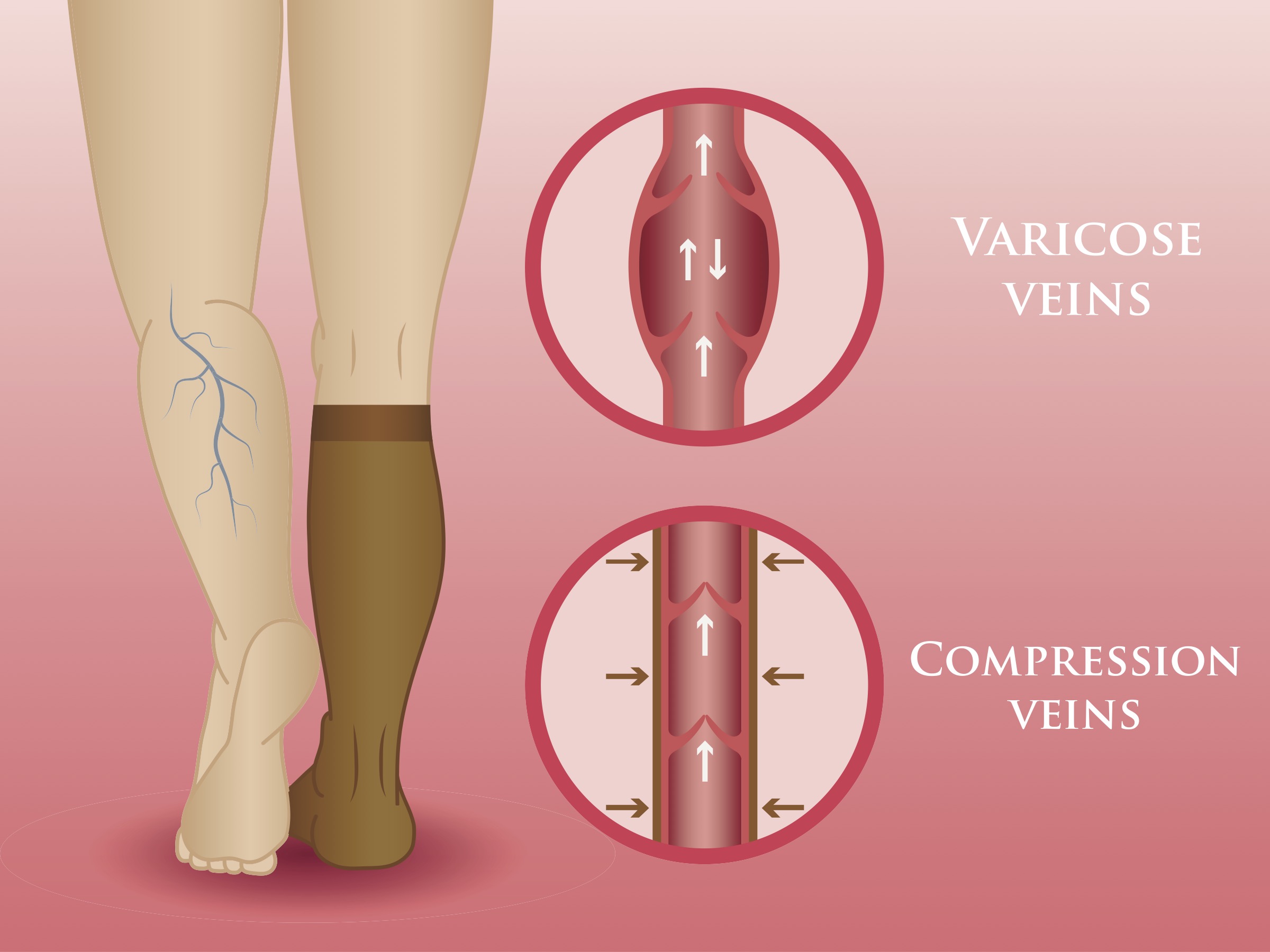 Illustration Showing One Leg with Varicose Veins and One Leg Supported by Wearing Compression Stockings.