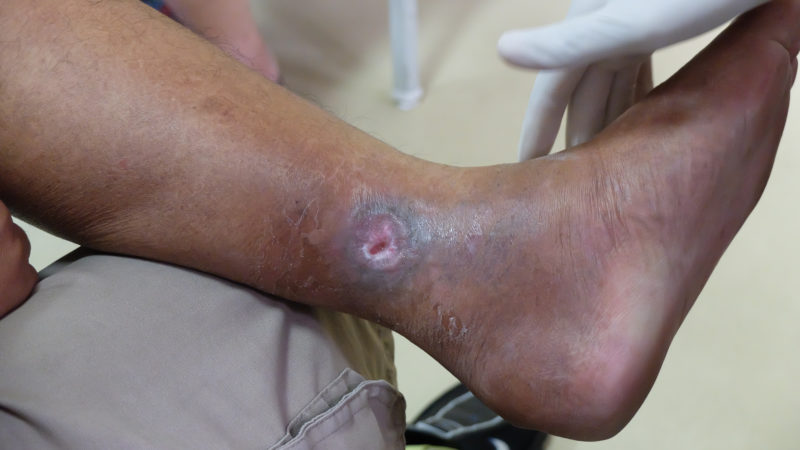 Typical venous ulcer with leg swelling, discolouration and skin thickening.