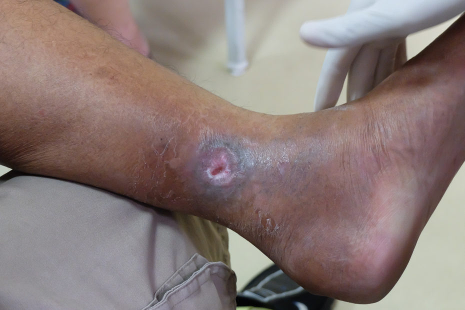 Venous Ulcer Just Above the Ankle. Leg Crossed.