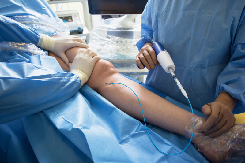 Varicose Veins Procedure Using VenaSeal Closure System on One Leg