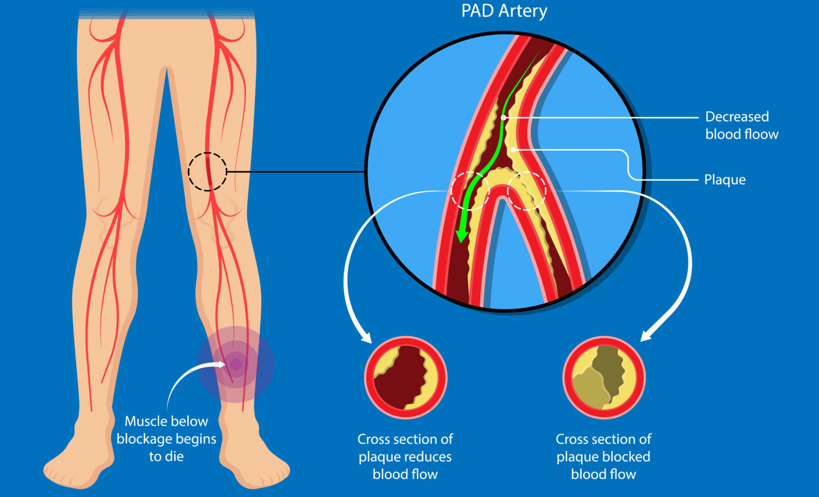 PAD Artery Disease