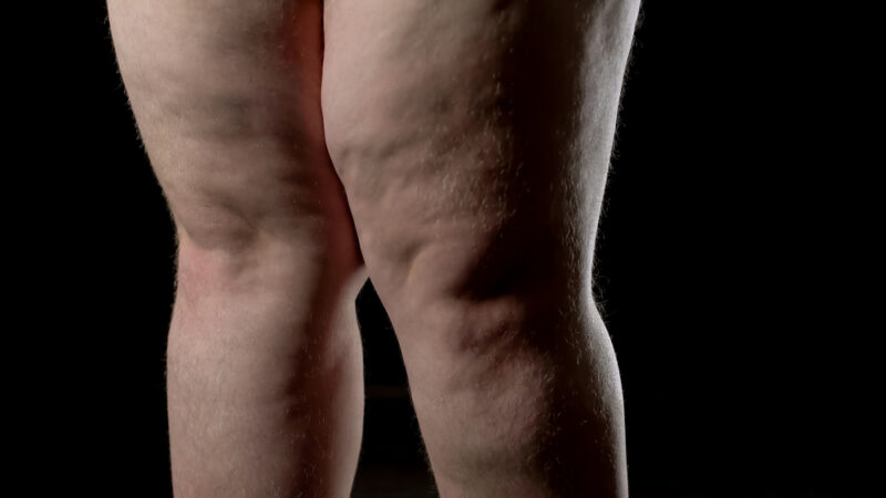 Showing,Cellulite,Male,Upper,Legs,With,Stretch,Marks,Hormonal,Disorder,Skin,Care,Lipoedema,Symptoms.