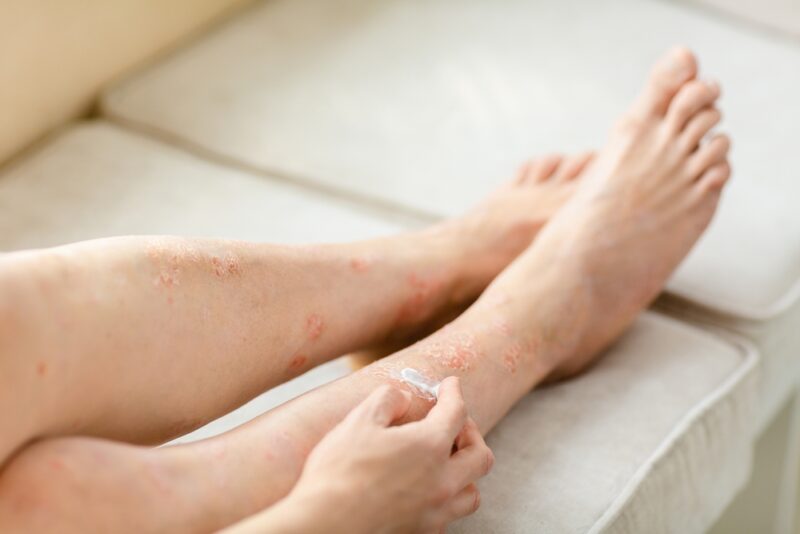 Varicose,Veins,Eczema,Cream,Being,Applied,to,Legs.