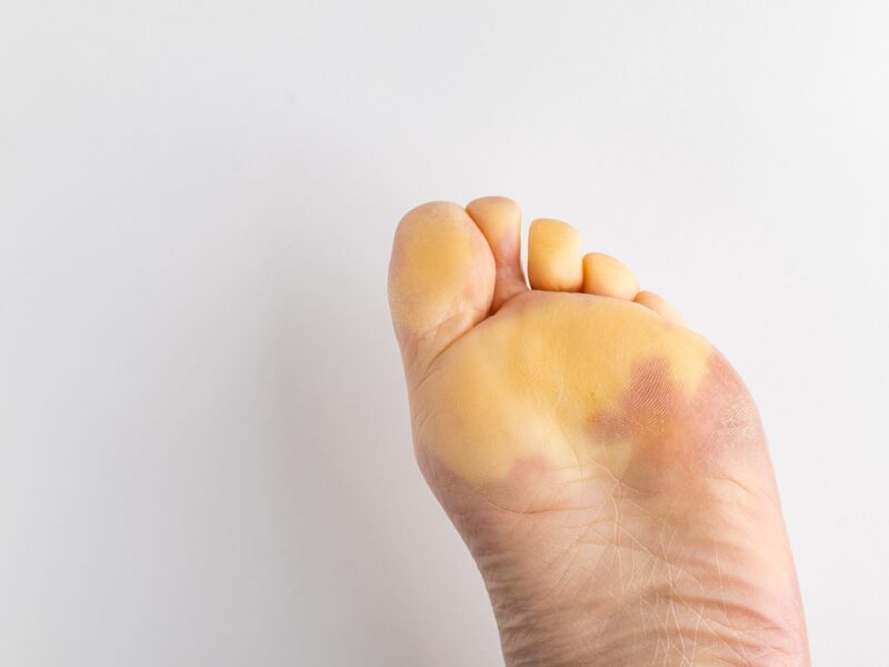 Foot,Of,White,Woman,Suffering,From,Rheumatological,Autoimmune,Disease.,Reynaud's