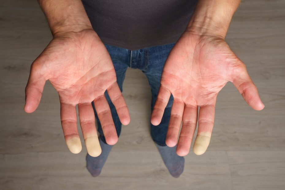 Man,Showing,Hands,With,Raynaud,Syndrome,,Raynaud's,Phenomenon,Or,Raynaud's,Vascular,Condition,White,Patches,On,Three,Fingers.