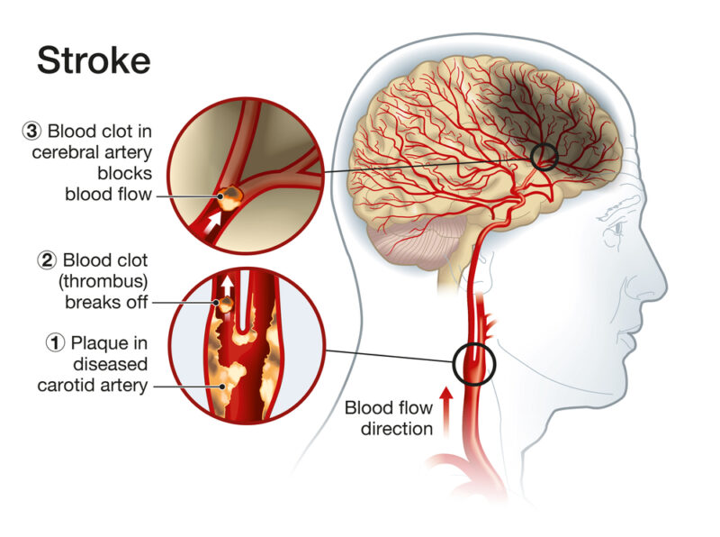 Illustration,Showing,Plaque,In,Carotid,Artery,,Blood,Clot,Breaking,Off,May,Cause,Stroke,Patient,May,Have,Carotid,Artery,Stenosis.