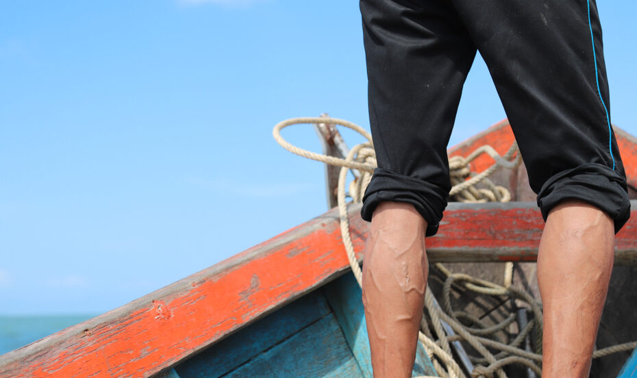 Closeup,Of,Varicose,Veins,On,Male,On,Fishing,Boat,Venous,Insufficiency,Leaking,Veins.