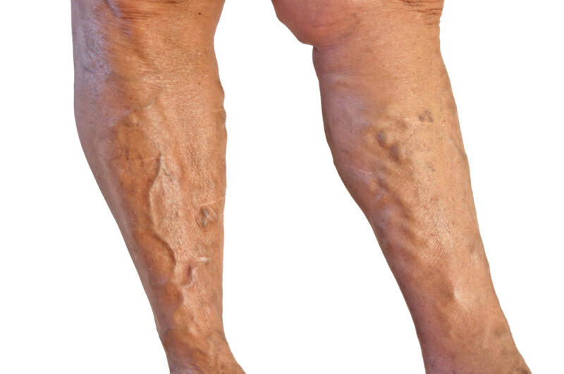 Two,Tanned,Legs,With,Varicose,Veins,On,White,Background,Venous,Insufficiency,Leaking,Veins.