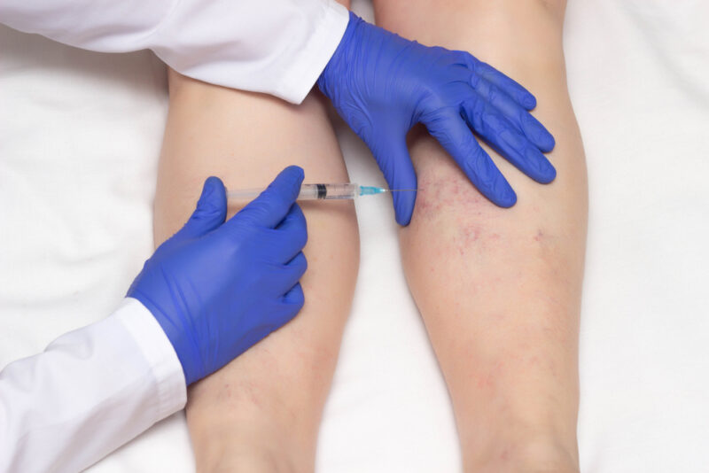Doctor,In,Medical,Gloves,Injects,Sclerotherapy,Procedure,On,The,Legs,For,Varicose,Veins