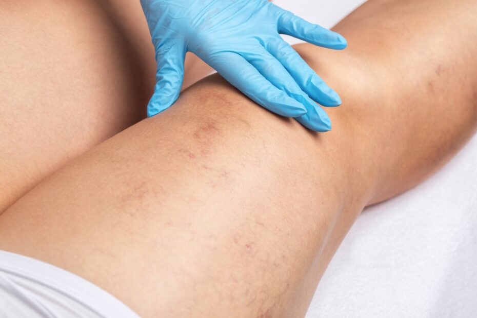 Removal,Of,Varicose,Veins,On,The,Legs.,Medical,Inspection,Ready,For,Sclerotherapy,Injections.